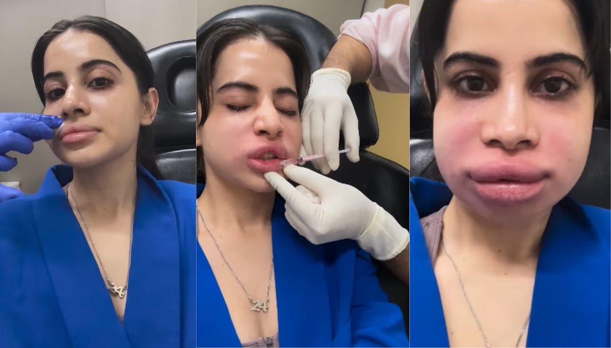 Uorfi Javed’s Lip Filler Removal Journey